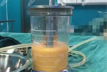 白城360度水动力吸脂费用多少钱？
