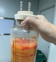 白城水动力吸脂手术要做多久？
